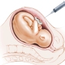 amniocentesis (1)